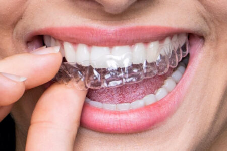 A beautiful girl has partially worn invisalign dental braces, she is smiling.