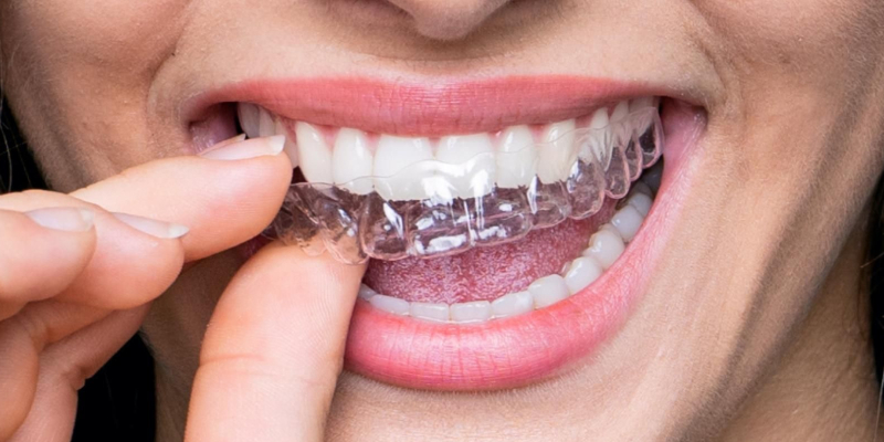 A beautiful girl has partially worn invisalign dental braces, she is smiling.