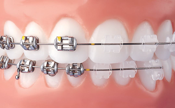 Metal brace has been fit on the teeth in the open mouth.